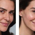 Что такое Skinvive от Juvederm? Процедура для сияющих щек, описание